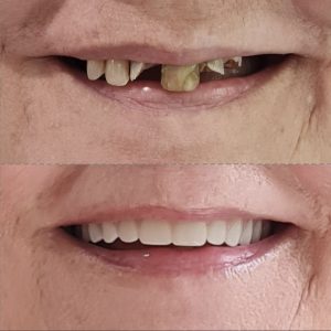 before and after dentures