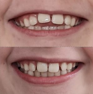 before and after invisalign