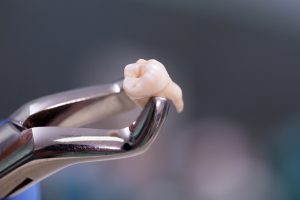 an extracted wisdom tooth
