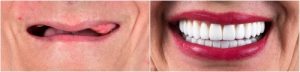 before and after dentures