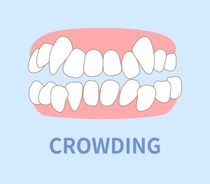 tooth crowding