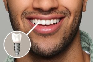 man with a dental implant