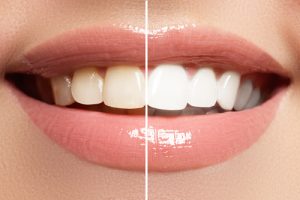 before and after teeth whitening 