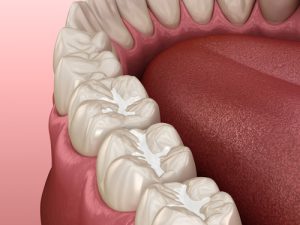 dental filliings
