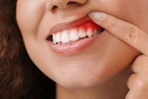 gum inflammation