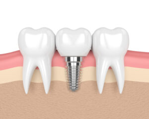 implant